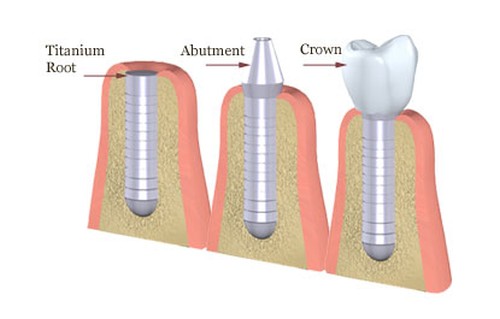 implantologia dentaria
